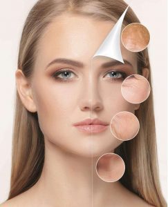 prp yüz bölgesine uygulanışı